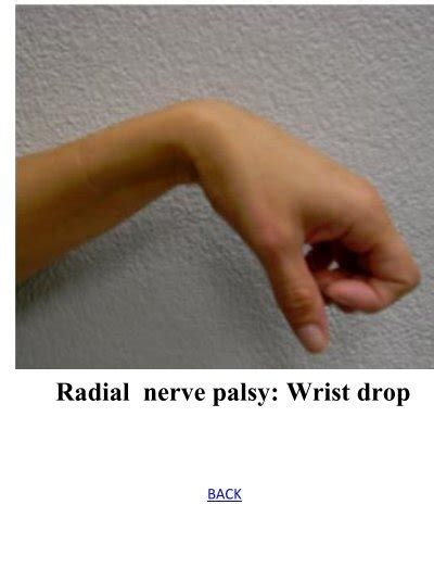 Radial Nerve Palsy Wrist
