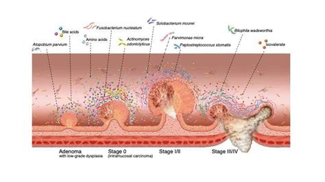 Depends on the location of the mutation on the apc gene. A gut feeling: Microbiome changes may mean early detection ...