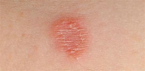 Smooth Red Patches On Skin Prnso