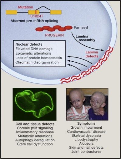 Hutchinson Gilford Progeria Syndrome Hgps Bioxone