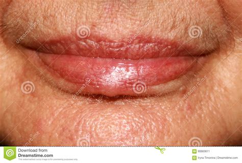 Lips Silicone Nasolabial Folds Wrinkles Around The Mouth Stock Image