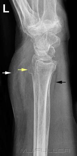 Soft Tissue Signs In Orthopaedics Wikiradiography