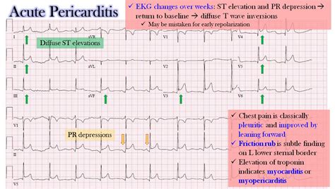The pericardium holds the heart in place and helps it work properly. Acute Pericarditis - EKG Changes EKG Progression ... | GrepMed