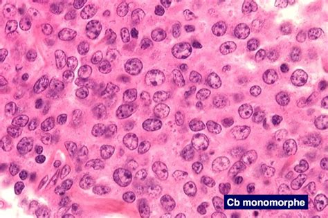 Lymphomes Diffus à Grandes Cellules B Lmnh B Horizons Hémato