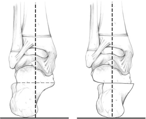 Medial Calcaneal Slide The Calcaneus Is Cut Parallel To The Posterior