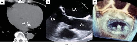 Figure 1 From A Calcified Amorphous Tumor Causing Mitral Valve