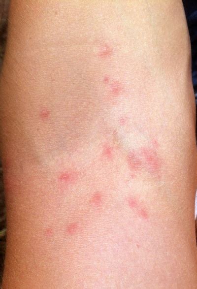Als quaddeln bezeichnet die medizin weißliche bis gerötete veränderungen (effloreszenzen) auf der haut, die in unterschiedlichen größen auftreten und mit gewebswasser gefüllt sind. Eichenprozessionsspinner-Allergie - Ursachen, Symptome ...