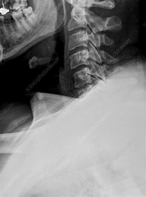 X Ray Of A Human Cervical Spine Stock Image C0197364 Science