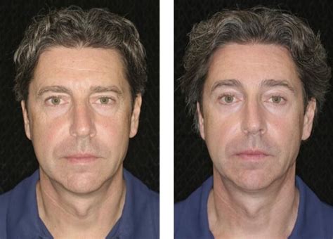 Laser Skin Resurfacing Fort Lauderdale Before And After Miami