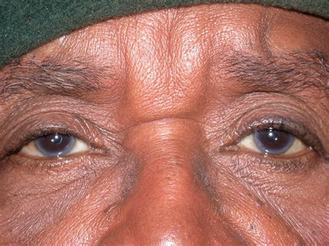 Eyelid Plastic And Reconstructive Surgery Warwar Eye Group