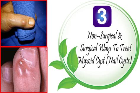 3 Non Surgical And Surgical Ways To Treat Myxoid Cyst Nail Cysts Nail