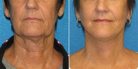 All You Want To Realize About Neck Lifts Without Surgery
