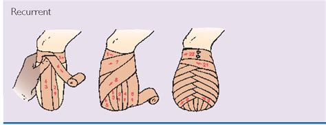 👍 Reverse Spiral Bandage Steps How To Use An Elastic Bandage 2019 01 12