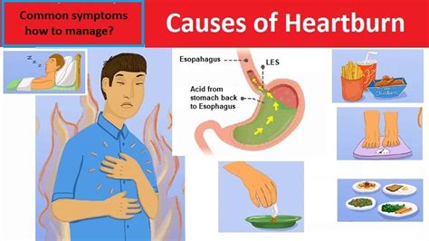 Causes Of Heartburn Common Symptoms How To Manage Helal Medical