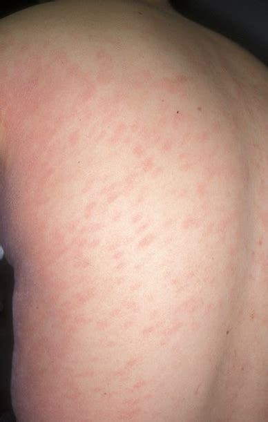 Viral Exanthem In Adults Pictures Photos