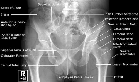 Adult Pelvis Ap View Male Pelvis Radiographic Anatomy Radiology