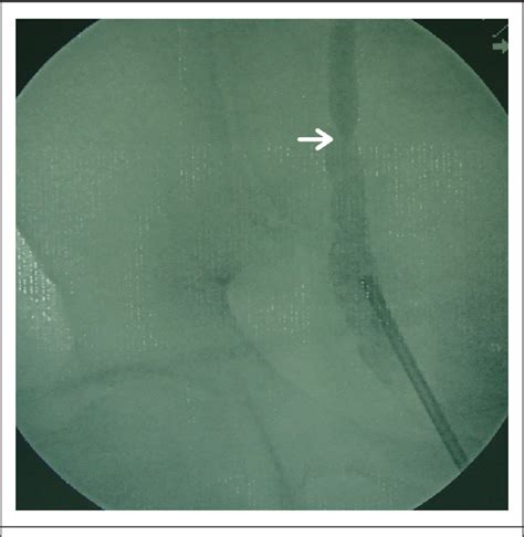 Figure From A Rare Case Of Successful Endoscopic Management Of A