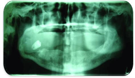 Orthopantomograph Shows Edentulous Maxilla And Partially Edentulous