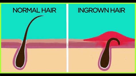 The tip of the hair will exit the skin. How to Get Rid of Ingrown Hair । Ingrown Hair Removal at ...