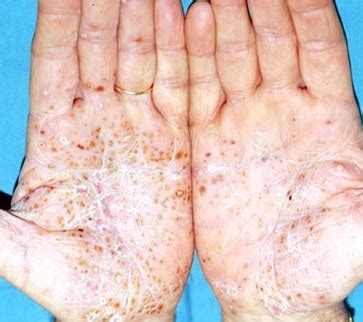 Psoriasi - cause e sintomi | Vicini di pelle