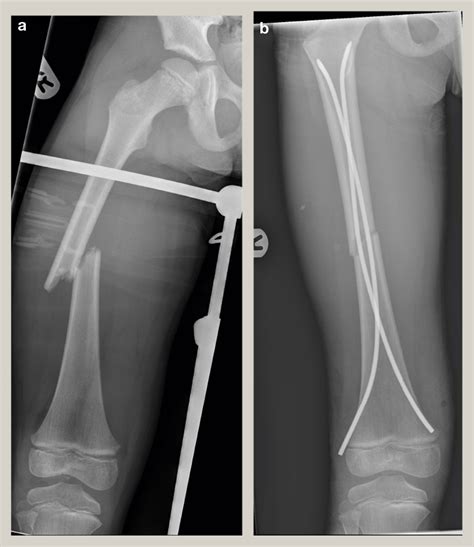 Common Paediatric Lower Limb Injuries Surgery Oxford International