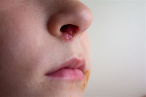 14 Signs Of Impetigo