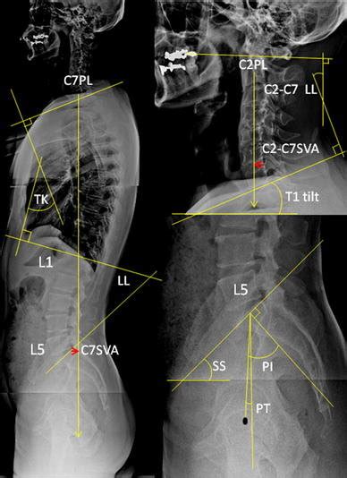 radiographic measurements of total spinal and pelvic parameters in download scientific diagram