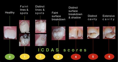 Dental Caries Diagram