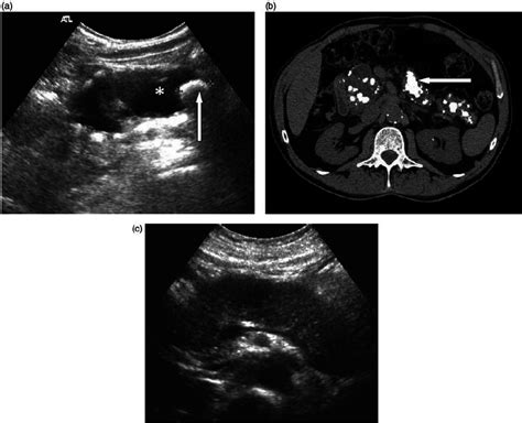 Chronic Pancreatitis A Axial Image Showing Atrophied Pancreas With