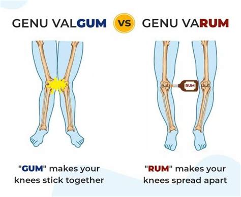 Genu Valgum Directions Knee Make It Yourself