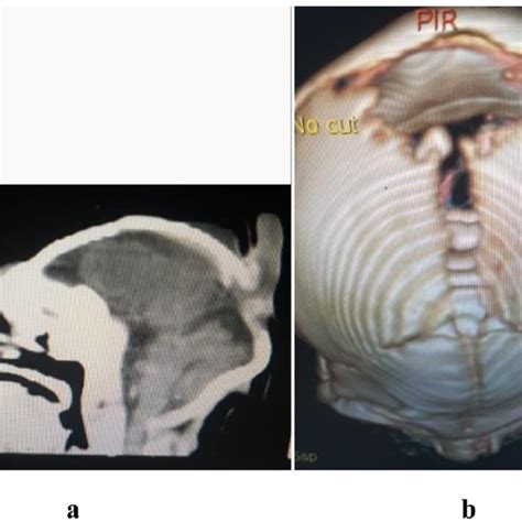 Pdf Hydrocephalus Associated With Occipital Encephalocele Surgical