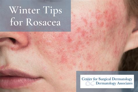 Dermatologists Top Tips For Calming Rosacea Flare Ups In The Winter