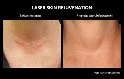 The Difference Between Laser Skin Rejuvenation And Skin Tightening