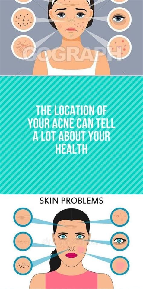 The Location Of Your Acne Can Tell A Lot About Your Health Healthy Pin