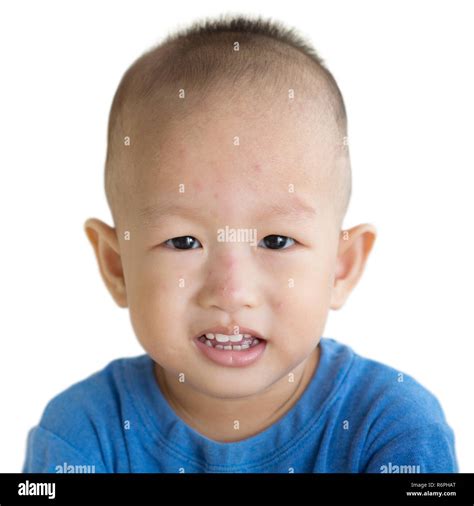 Toddler With Red Rashes On Face Stock Photo Alamy