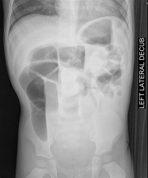 Not Movin Pediatric Bowel Obstruction Radiology Key