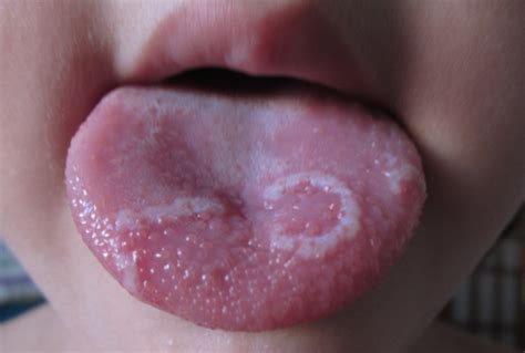 What Is Beefy Tongue And How Do You Get Rid Of It Geographic