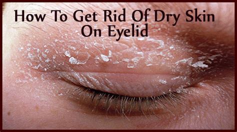 Ways To Relieve Dry Skin On Eyelids Naturally In No Time