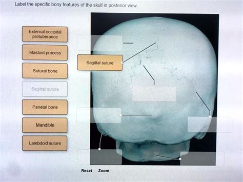 Solved Label The Specific Bony Features Of The Skull In Posterior View