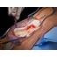 Tendon Rupture  The Foot And Ankle Online Journal
