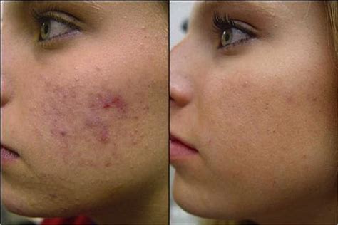 Here At Forever Young We Use The Sciton Laser Here Is A Before And