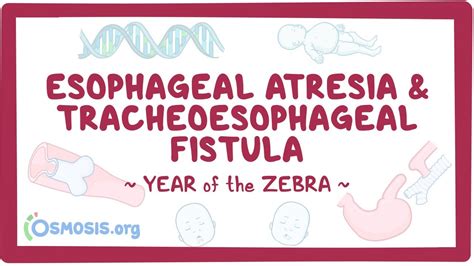 Esophageal Atresia Tracheoesophageal Fistula Year Of The Zebra
