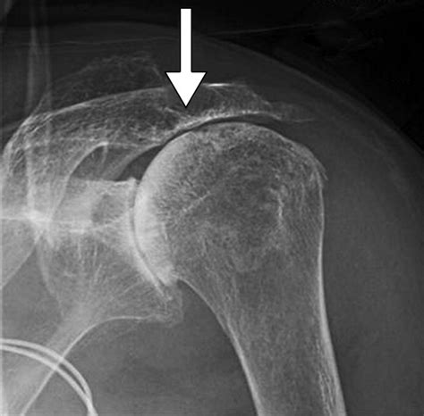Rotator Cuff Tear Arthropathy Pathophysiology Imaging Characteristics