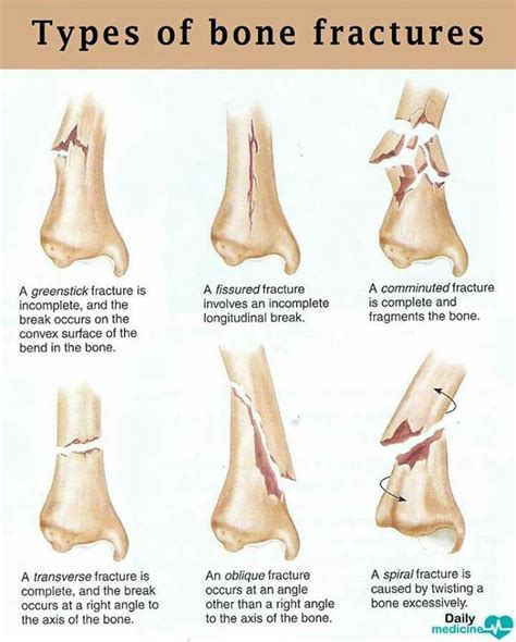 Types Of Bone Fractures Medical Terminology Study Medical School