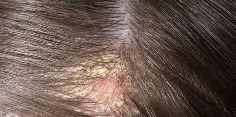Scalp Scabs Causes Symptoms And How To Heal No Body Problems Hair