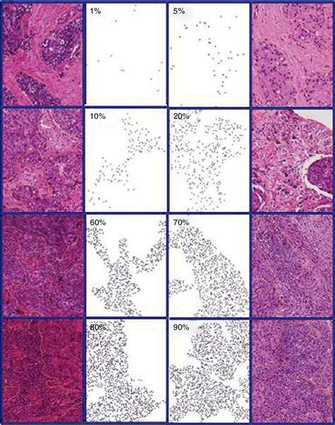 Figure 1 From The Evaluation Of Tumor Infiltrating Lymphocytes TILs