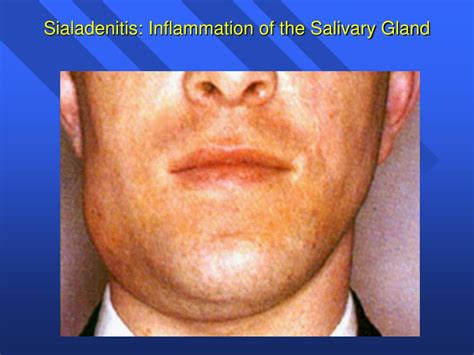 Salivary Gland Infections Pictures
