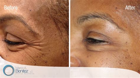 Best home remedies to remove wrinkles around mouth. Smile Lines Around Mouth - Ebony Foot Job