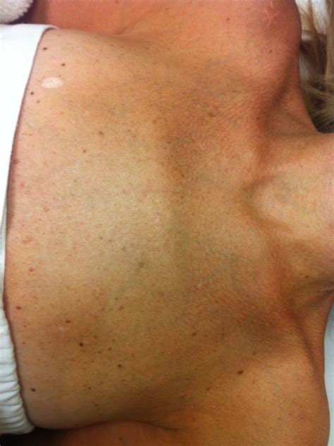 Pin On Age Spots