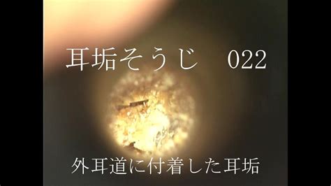 耳垢そうじ/耳が痒い/022 - YouTube